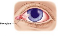 莫把翼状胬肉误当白内障 别等“长熟了”才切除